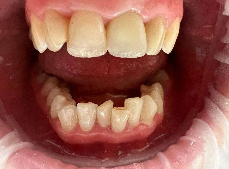 Implant Ankylos C/X z koroną Cut-Back — po