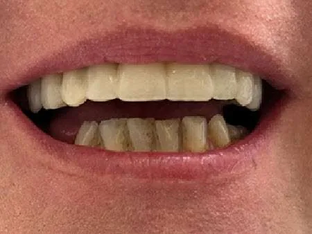 12-punktowy most pełnoceramiczny na 5 implantach — po