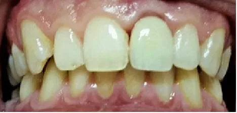 Implant Ankylos C/X z koroną Cut-Back — zaraz po przykręceniu