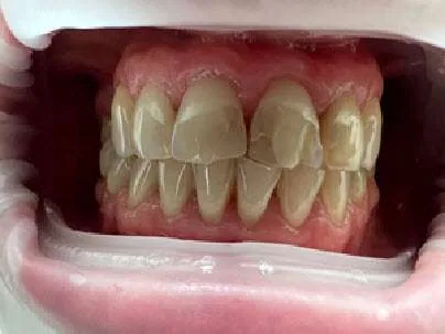 Zęby przednie przed licówkami porcelanowymi