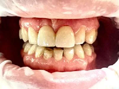 Implant Ankylos (prawa) + korona Cut-Back (lewa) — po