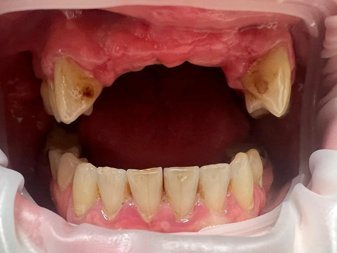 Brakujące siekacze — przed mostem na implantach