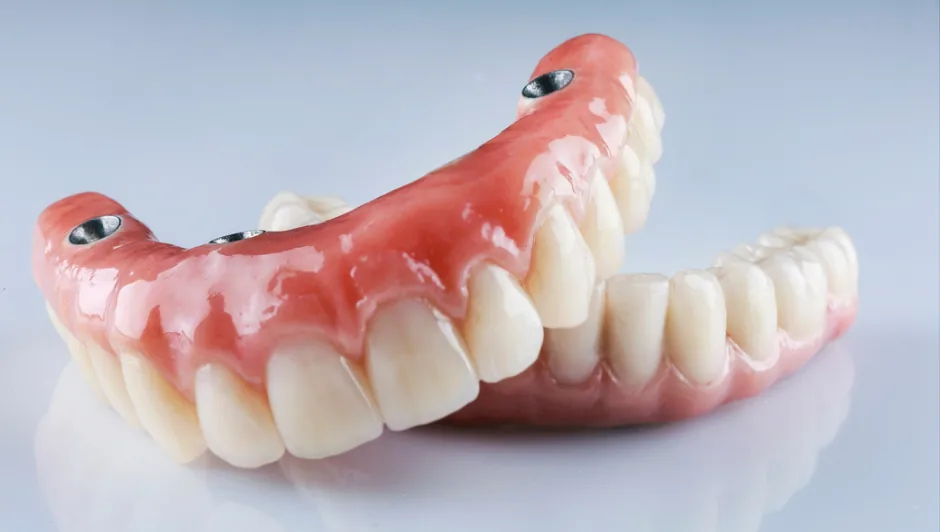 Proteza overdenture na implantach — schemat