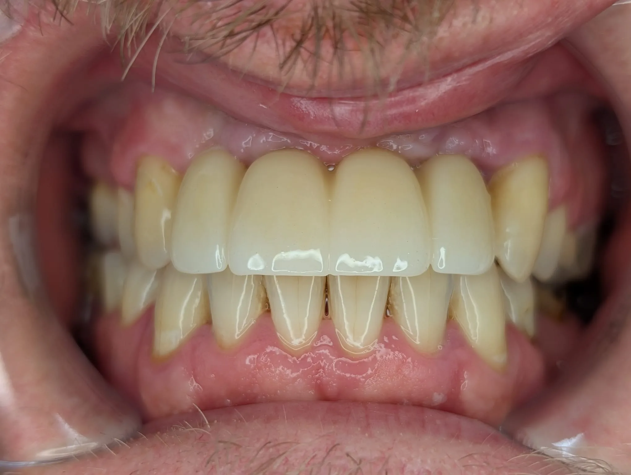 Uzupełnienie przednich zębów mostem na implantach — po