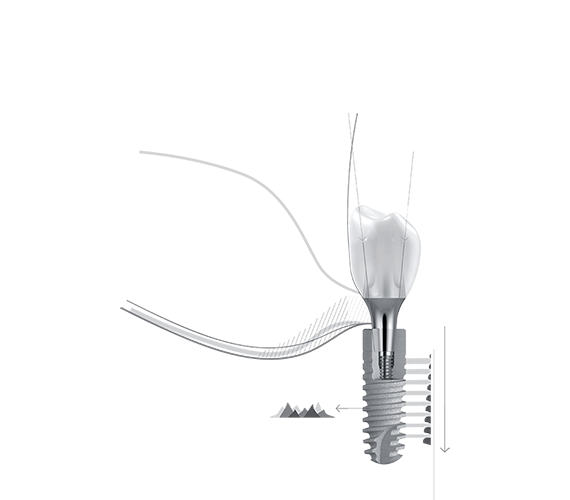 System implantów stomatologicznych Ankylos