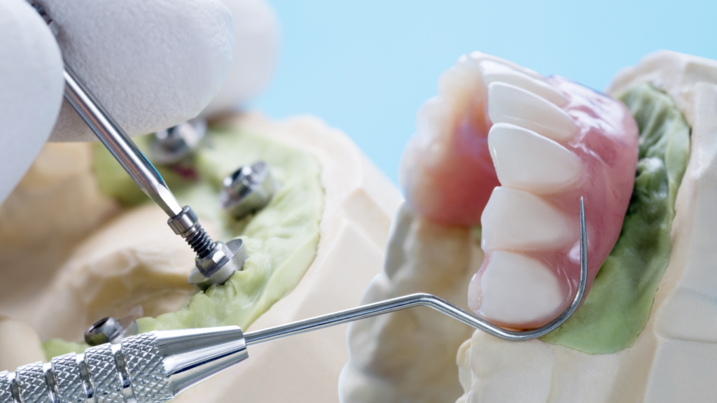 mocowanie protezy zębów
