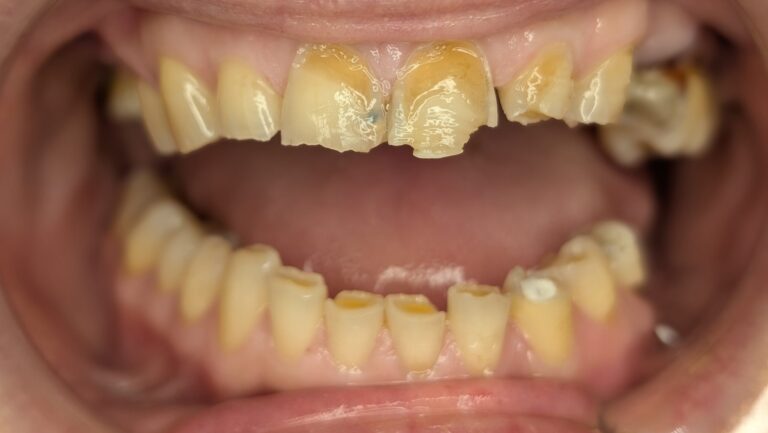 przed-bonding zębów w łuku górnym i dolnym